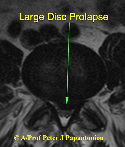 Large Disc Prolapse